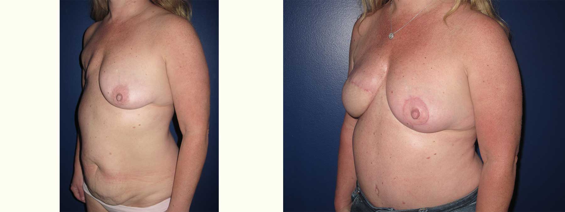 Before and After Image of Diep Flap Breast Reconstruction