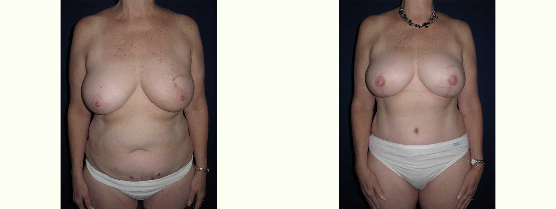 Before and After Image of Diep Flap Breast Reconstruction