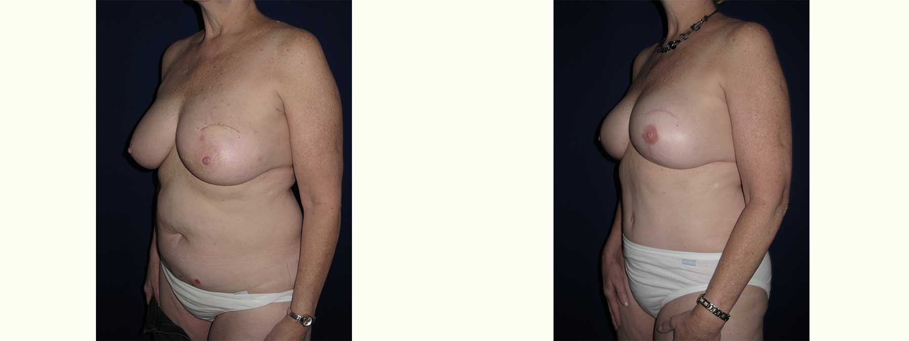 Before and After Image of Diep Flap Breast Reconstruction