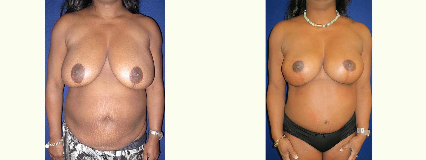 Before and After Image of Diep Flap Breast Reconstruction