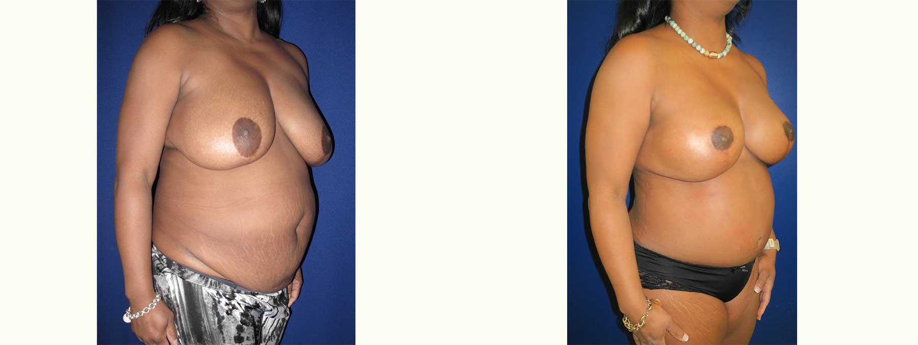 Before and After Image of Diep Flap Breast Reconstruction