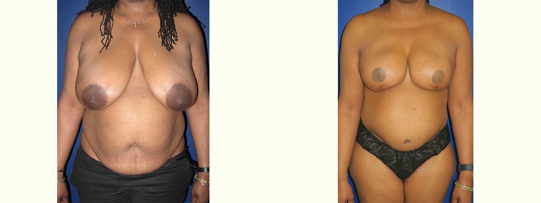 Before and After Image of Diep Flap Breast Reconstruction