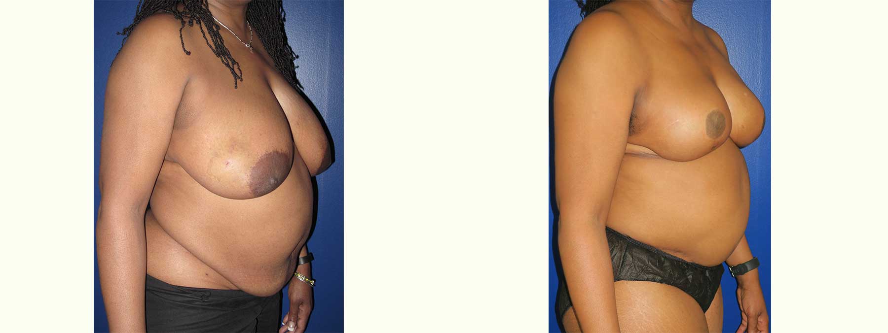 Before and After Image of Diep Flap Breast Reconstruction