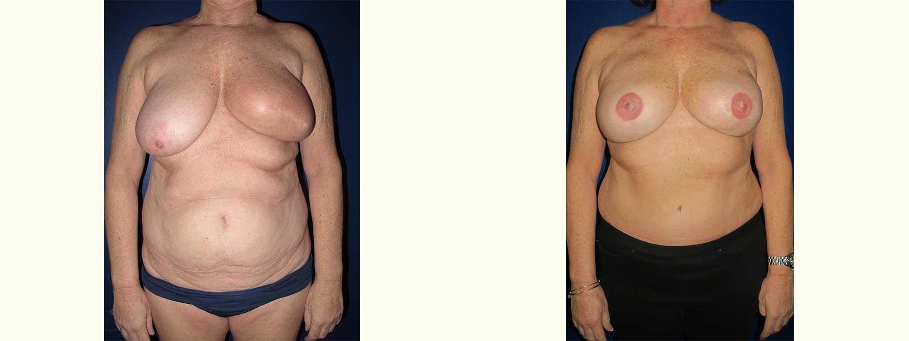 Before and After Image of Diep Flap Breast Reconstruction