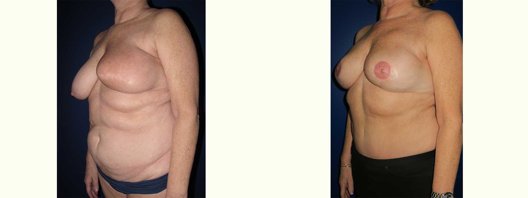 Before and After Image of Diep Flap Breast Reconstruction