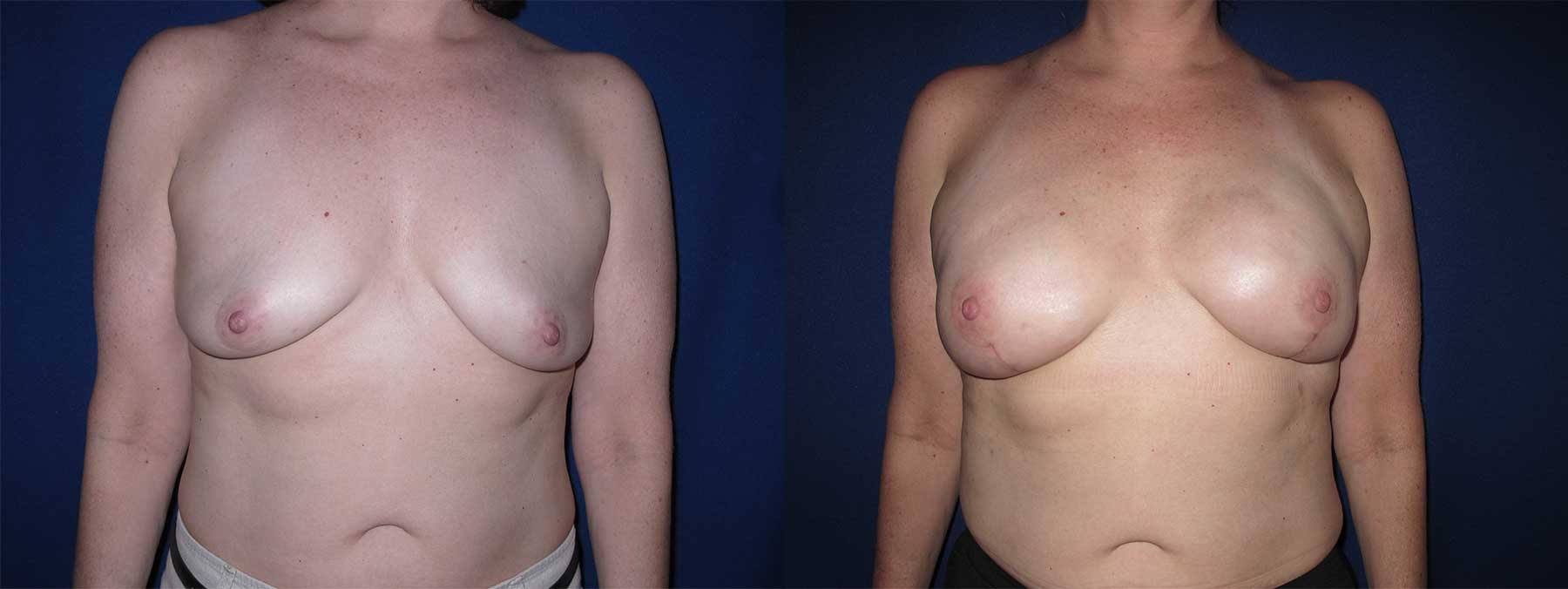 Before and After Image of Direct to Implant Reconstruction