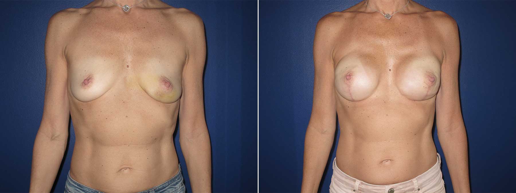 Before and After Image of Direct to Implant Reconstruction