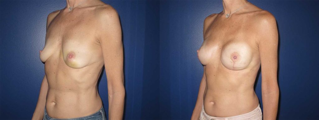 Before and After Image of Direct to Implant Reconstruction