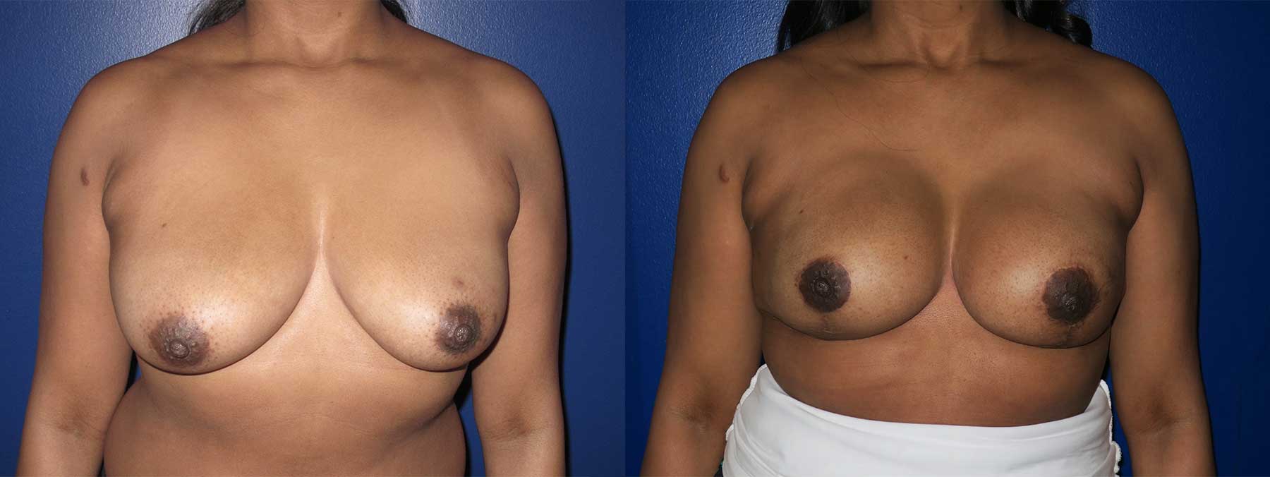 Before and After Image of Direct to Implant Reconstruction