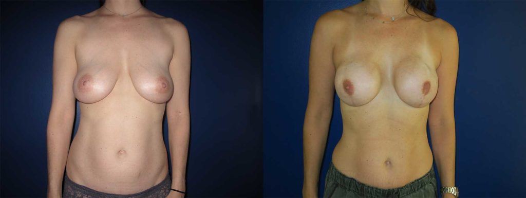 Before and After Image of Direct to Implant Reconstruction