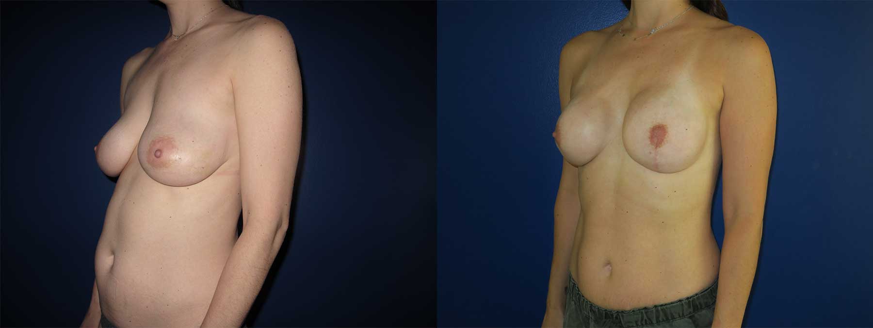 Before and After Image of Direct to Implant Reconstruction