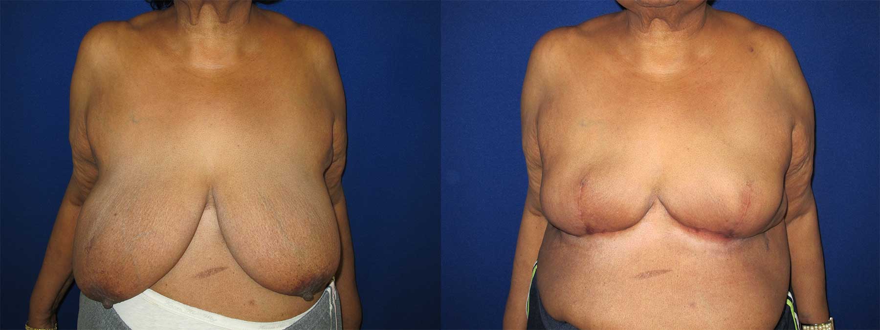 Before and After Image of Goldilocks Breast Reconstruction