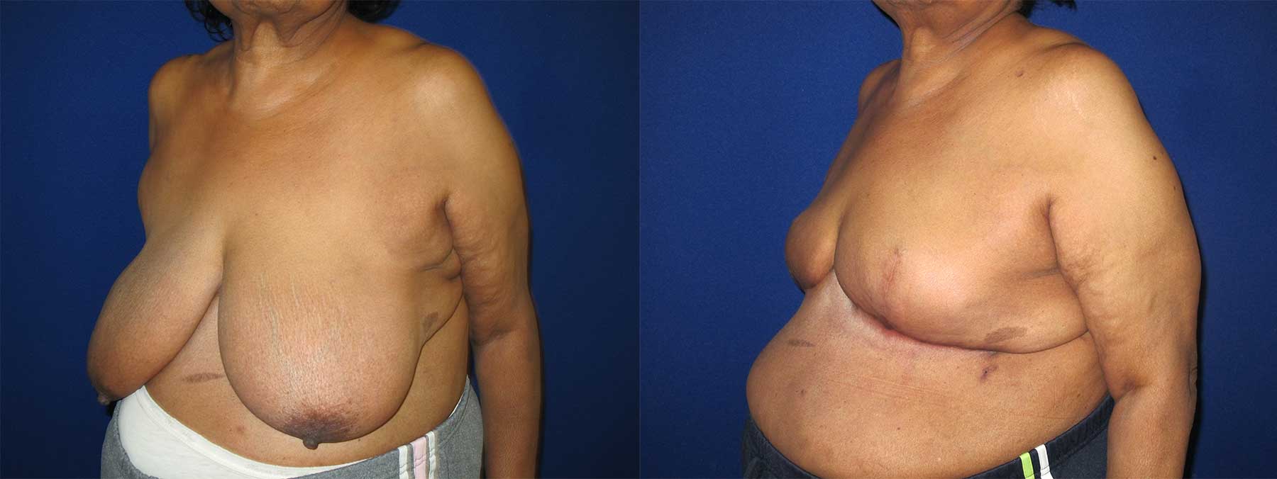 Before and After Image of Goldilocks Breast Reconstruction