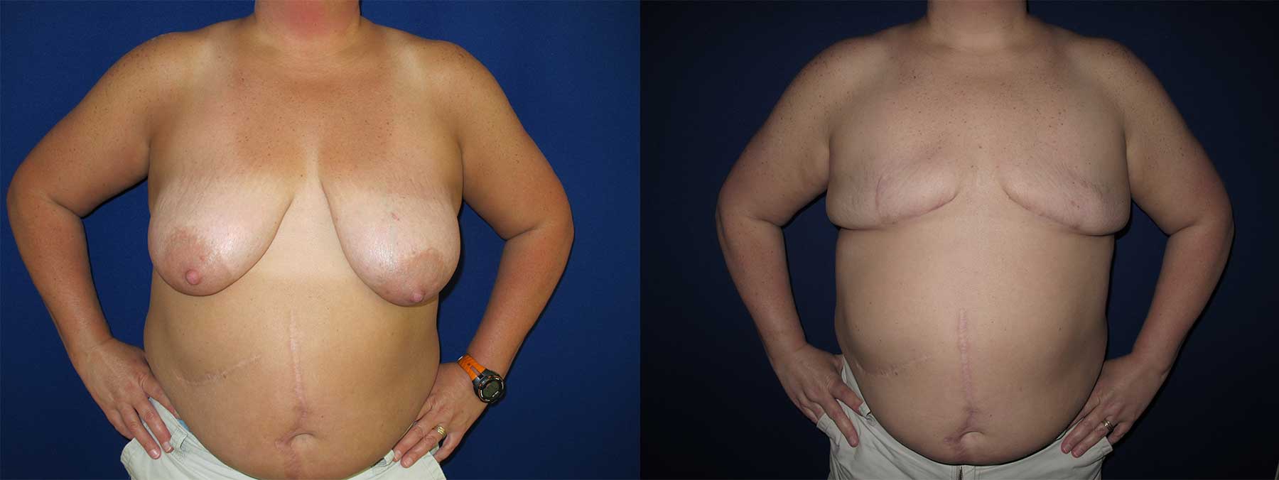 Before and After Image of Goldilocks Breast Reconstruction