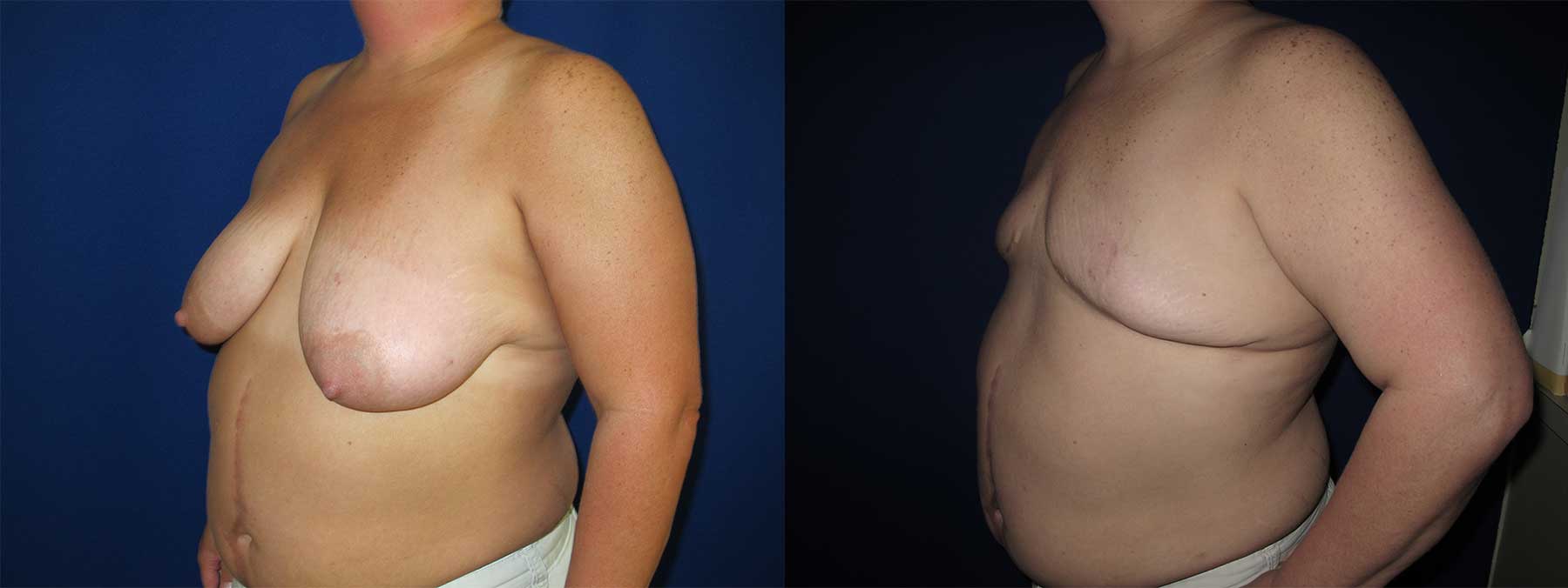 Before and After Image of Goldilocks Breast Reconstruction