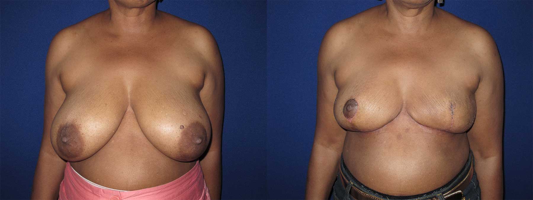 Before and After Image of Goldilocks Breast Reconstruction