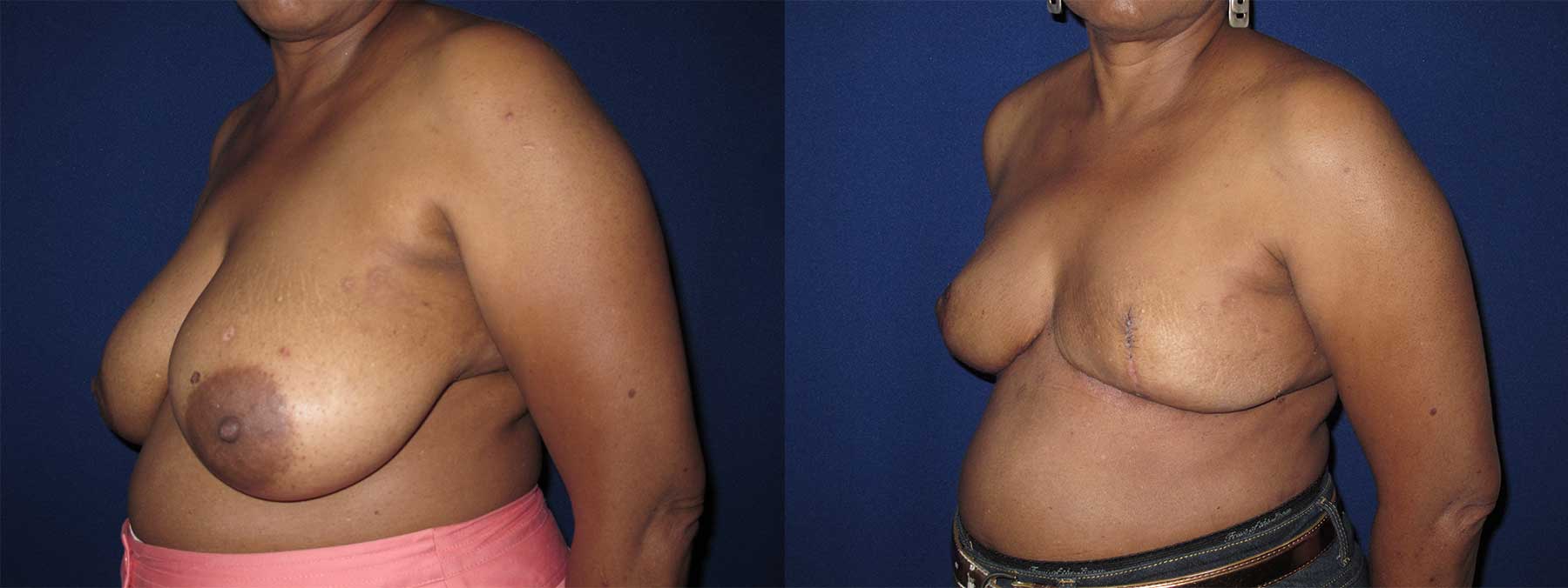 Before and After Image of Goldilocks Breast Reconstruction