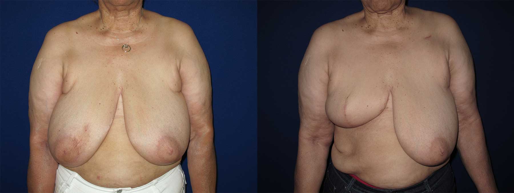 Before and After Image of Goldilocks Breast Reconstruction