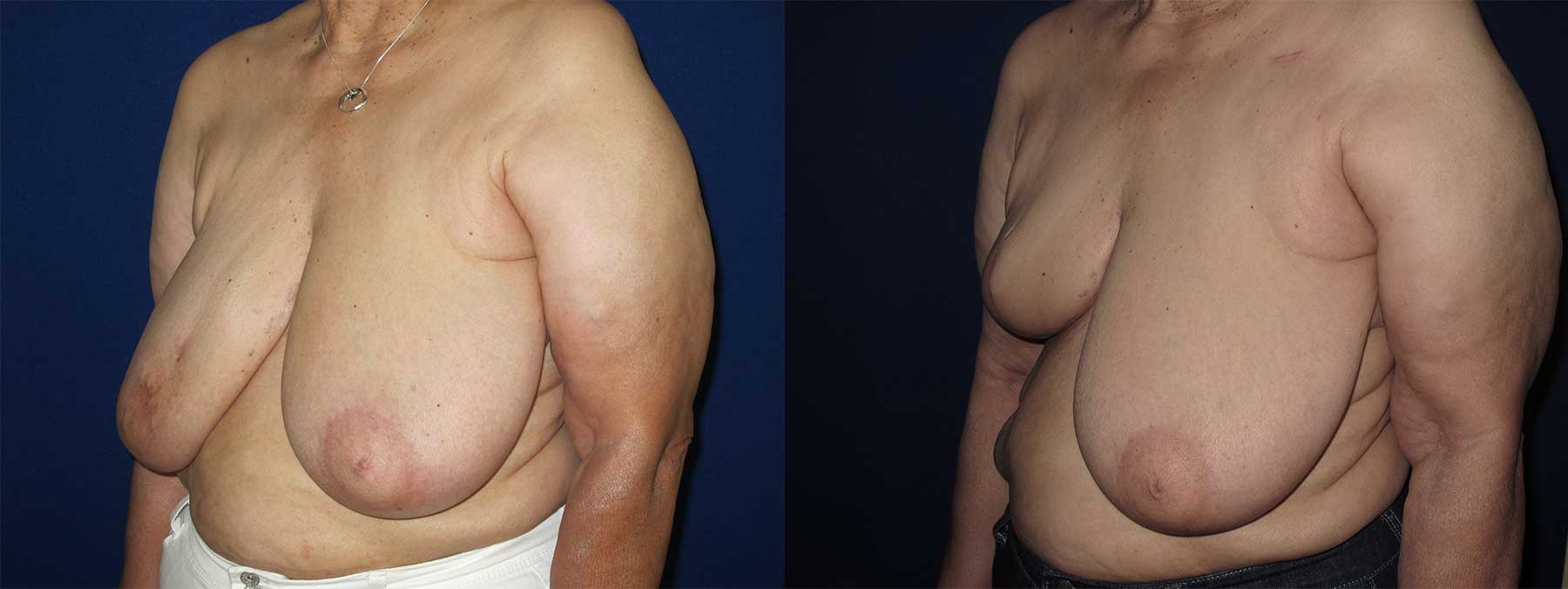 Before and After Image of Goldilocks Breast Reconstruction