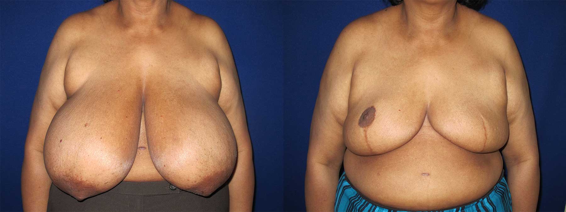 Before and After Image of Goldilocks Breast Reconstruction