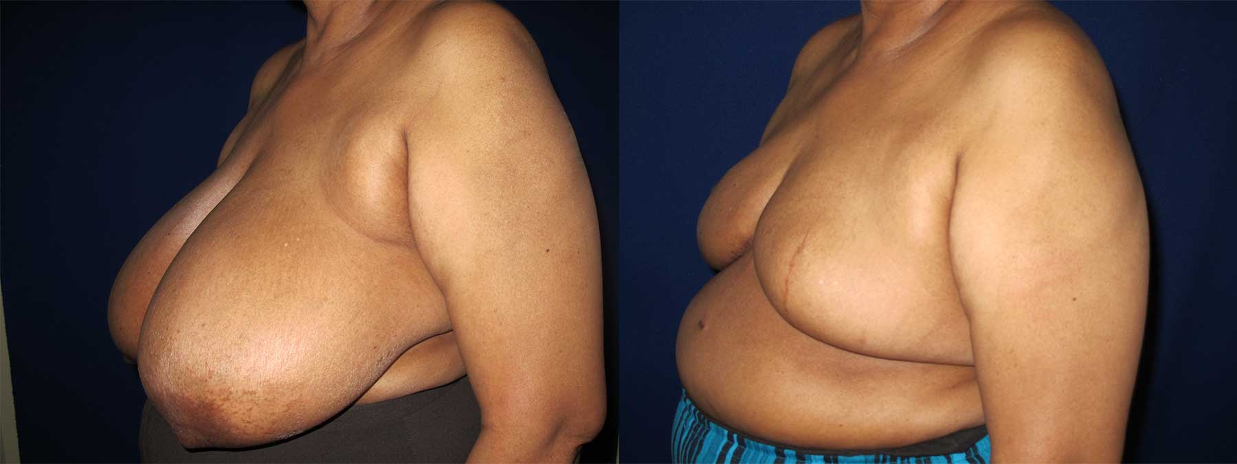 Before and After Image of Goldilocks Breast Reconstruction