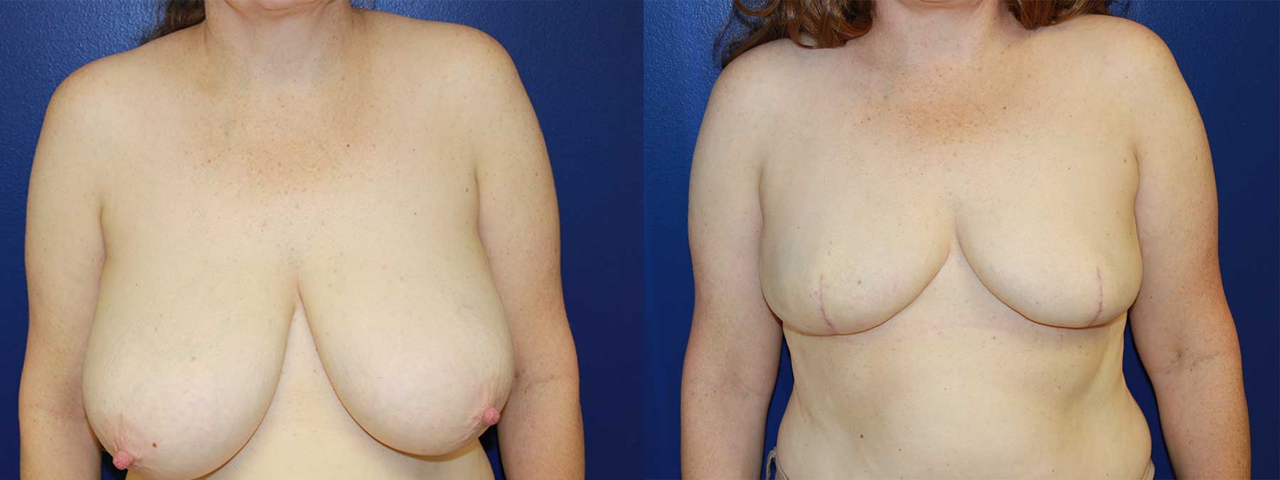 Before and After Image of Goldilocks Breast Reconstruction