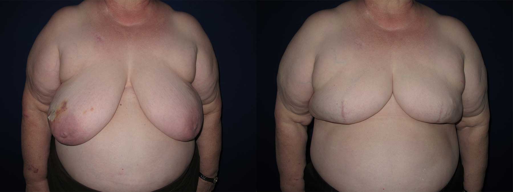 Before and After Image of Goldilocks Breast Reconstruction