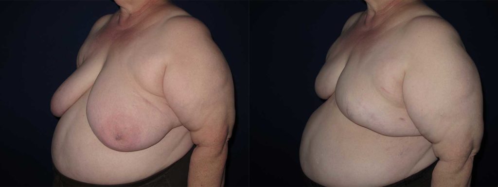 Before and After Image of Goldilocks Breast Reconstruction
