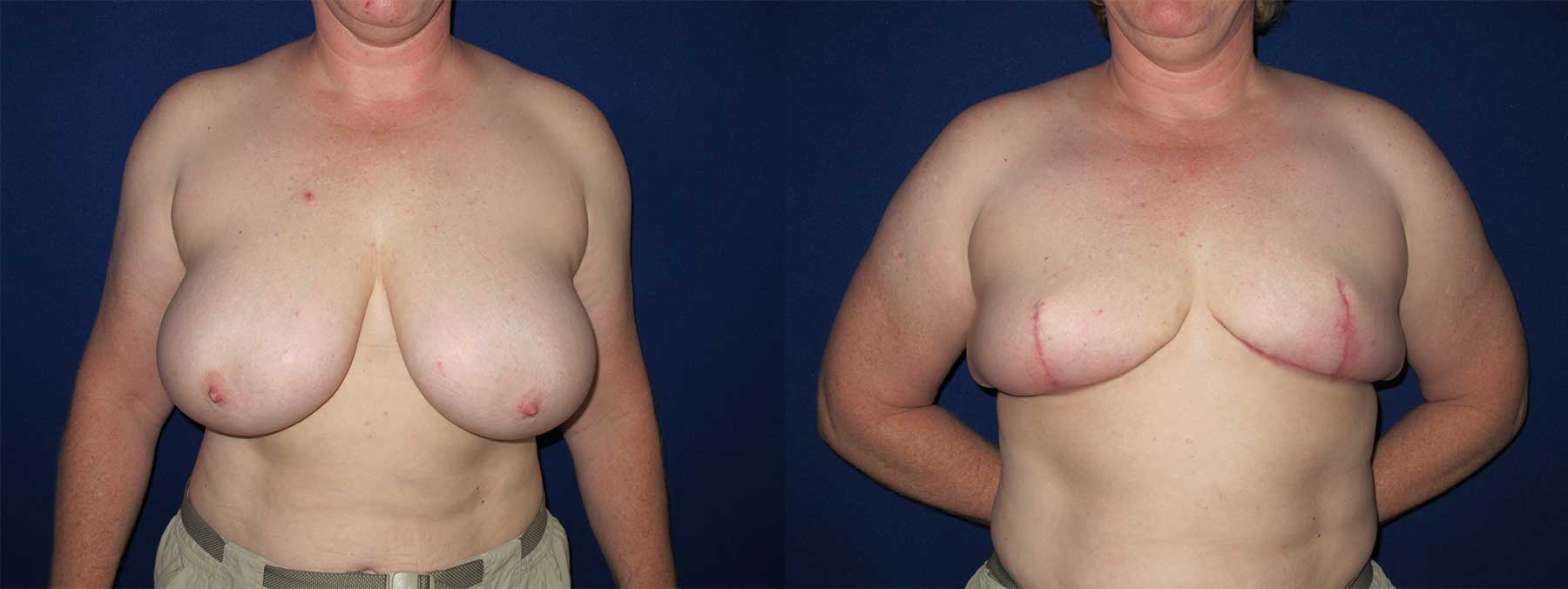 Before and After Image of Goldilocks Breast Reconstruction