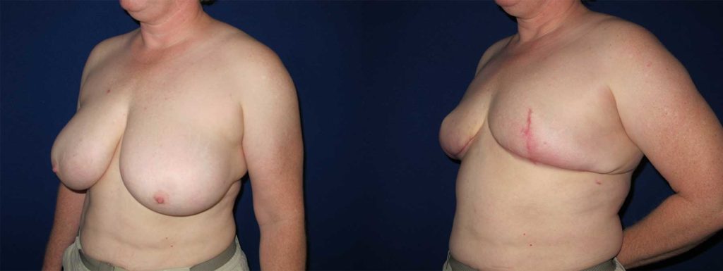 Before and After Image of Goldilocks Breast Reconstruction