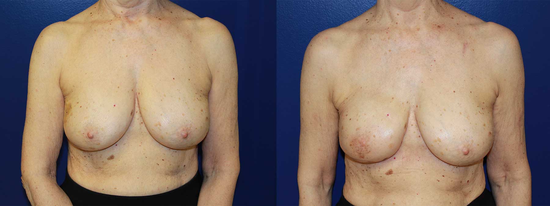 Before and After Image of Implant-Based Reconstruction