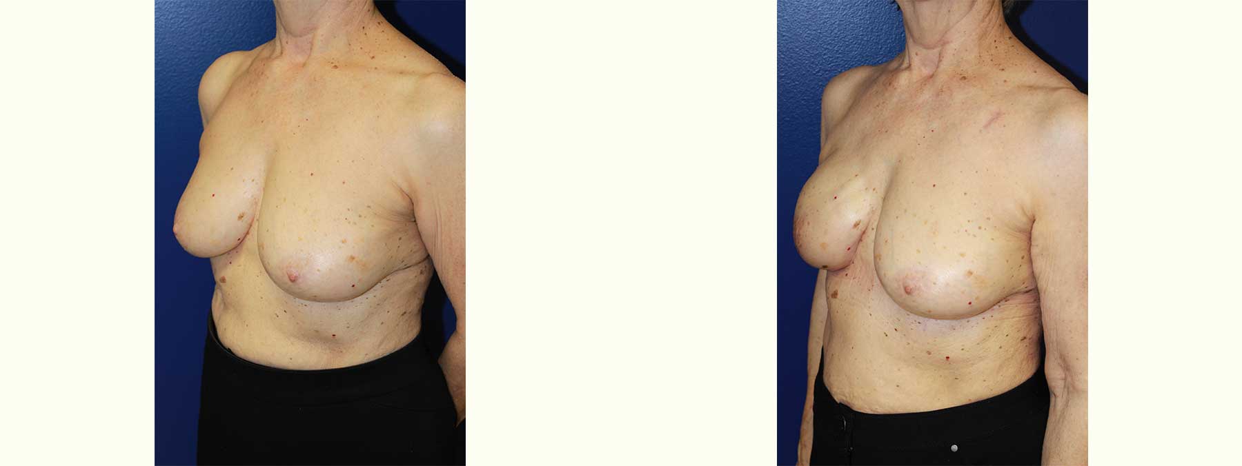 Before and After Image of Implant-Based Reconstruction