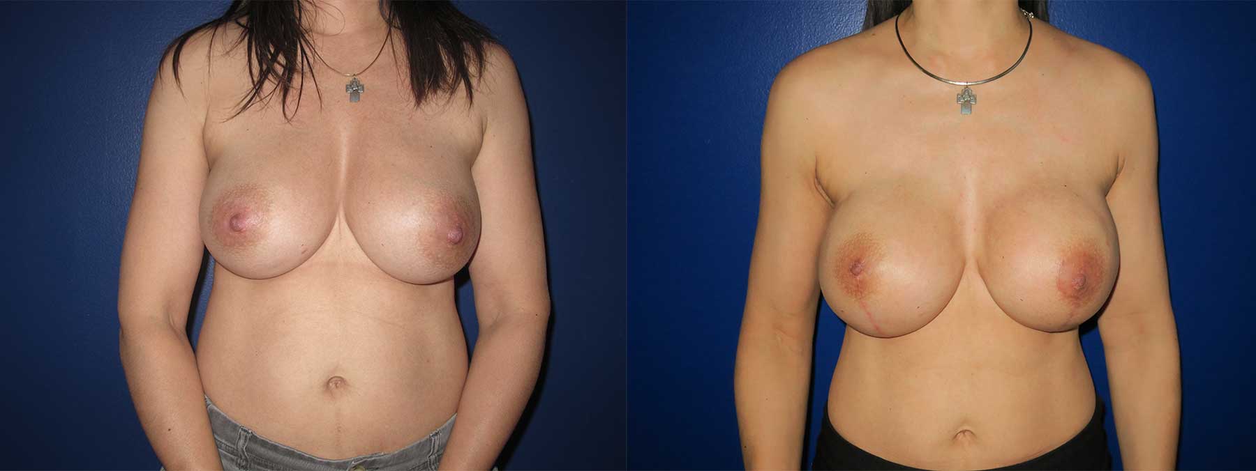 Before and After Image of Implant-Based Reconstruction