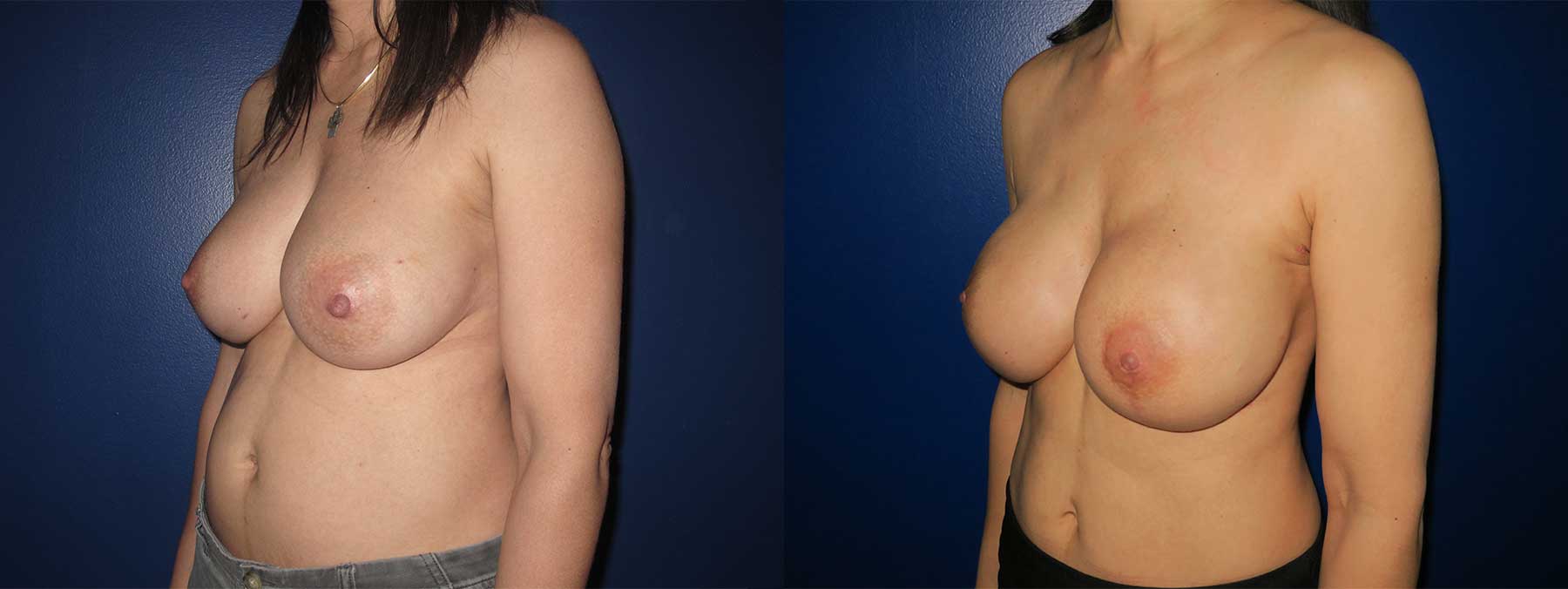 Before and After Image of Implant-Based Reconstruction