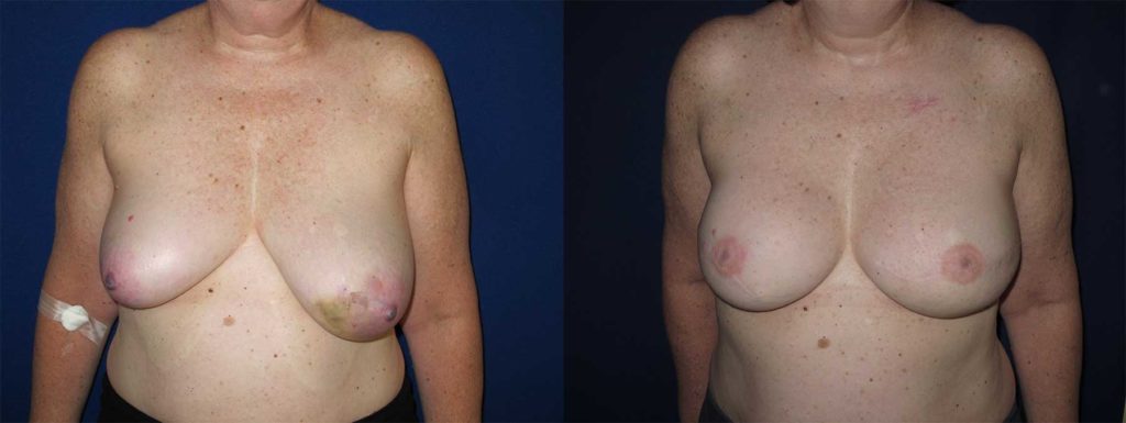 Before and After Image of Implant-Based Reconstruction