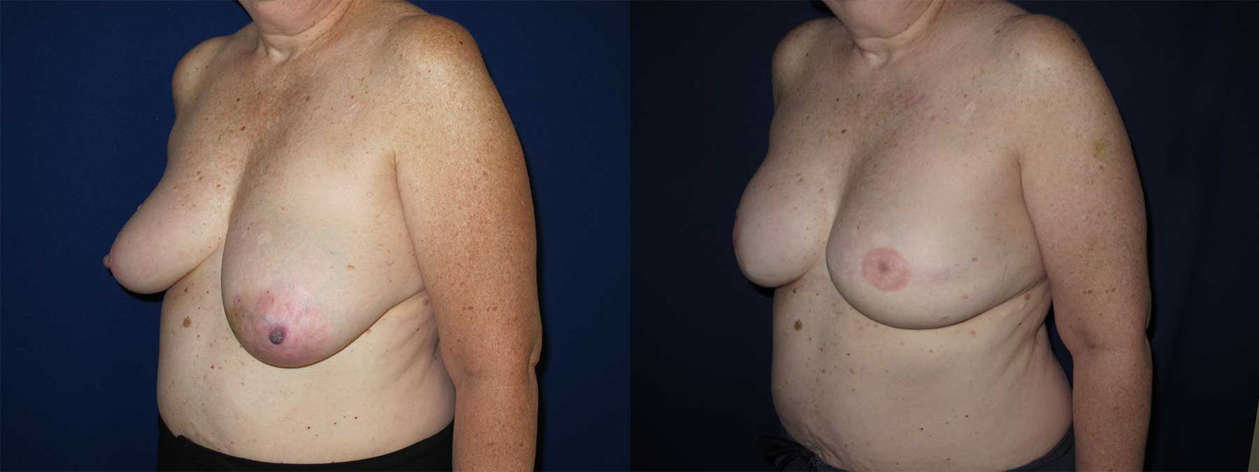 Before and After Image of Implant-Based Reconstruction