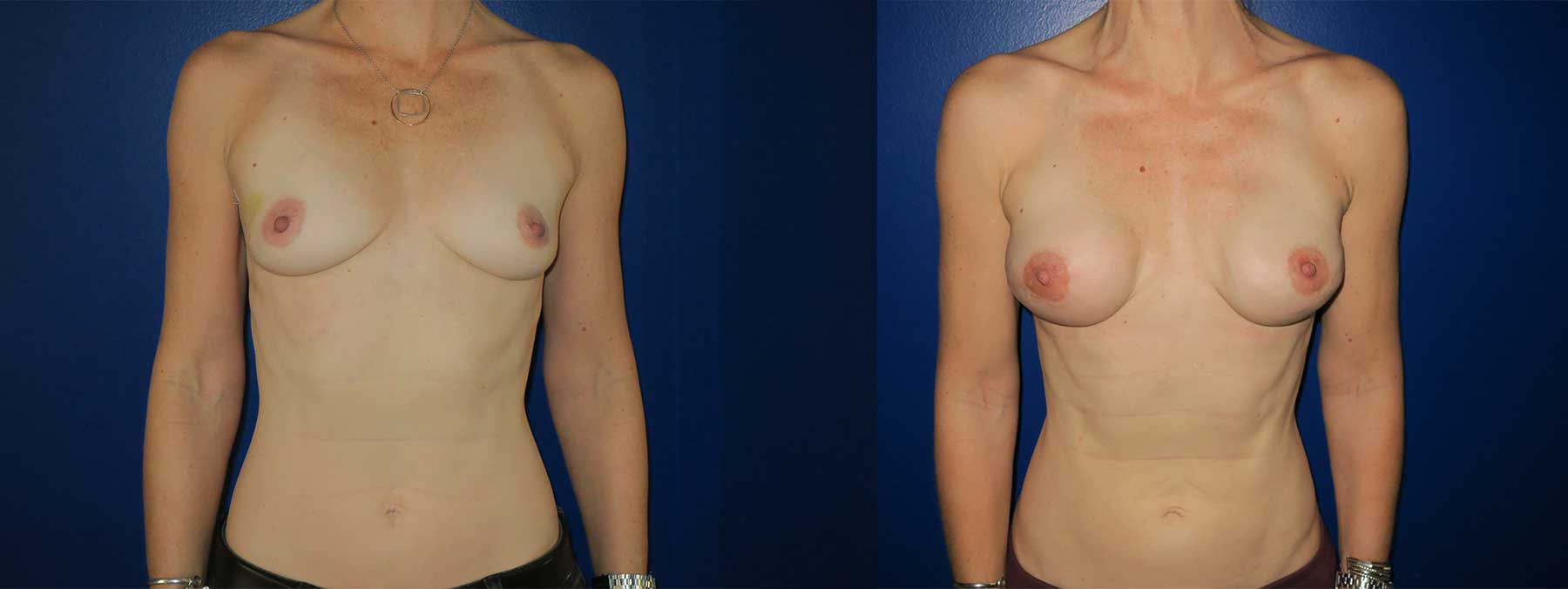 Before and After Image of Implant-Based Reconstruction