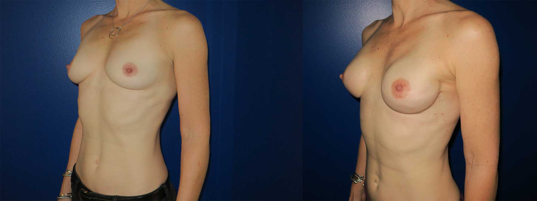 Before and After Image of Implant-Based Reconstruction