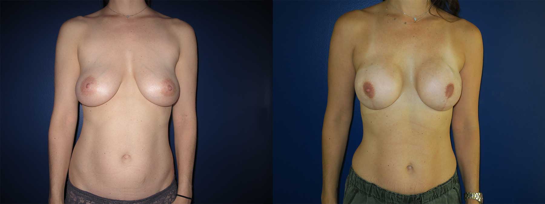 Before and After Image of Implant-Based Reconstruction