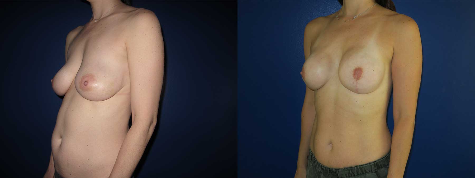 Before and After Image of Implant-Based Reconstruction