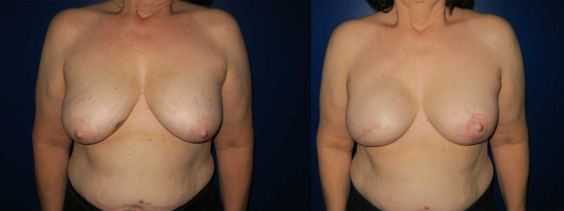 Before and After Image of Implant-Based Reconstruction