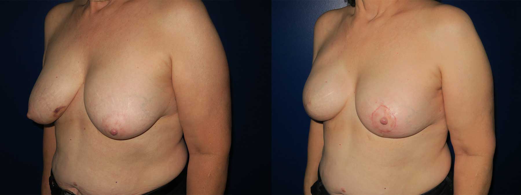 Before and After Image of Implant-Based Reconstruction