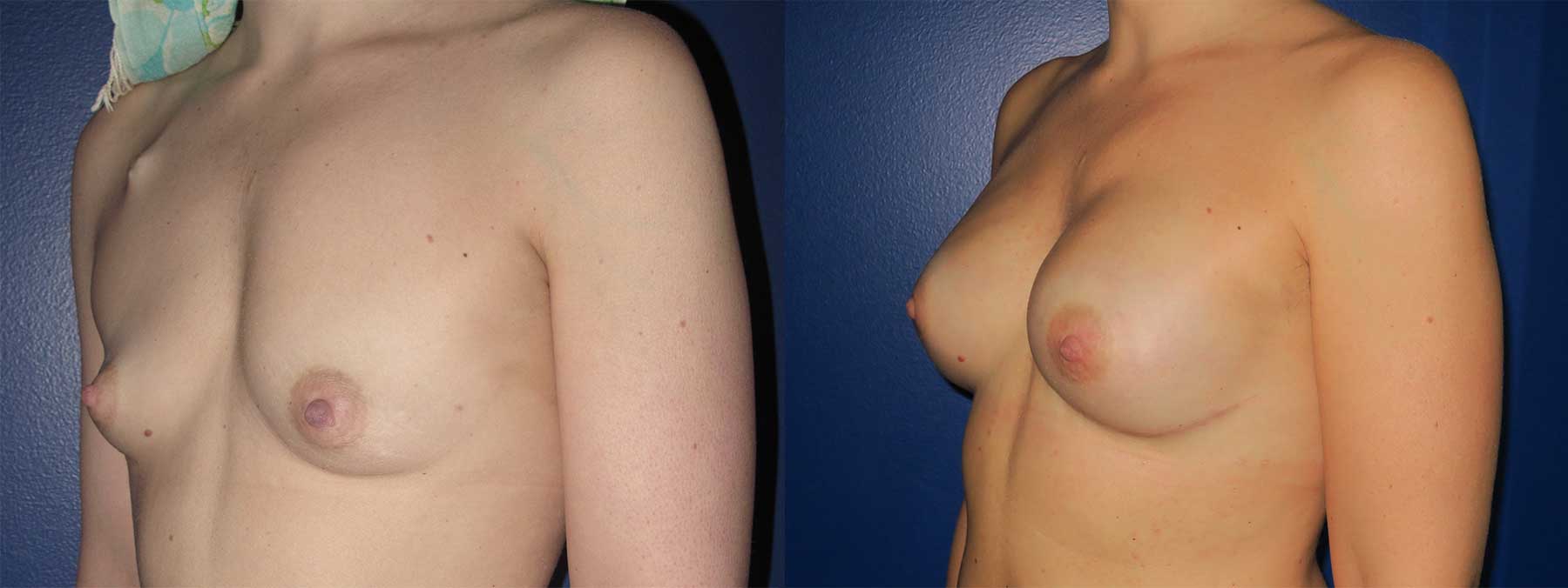 Before and After Image of Implant-Based Reconstruction