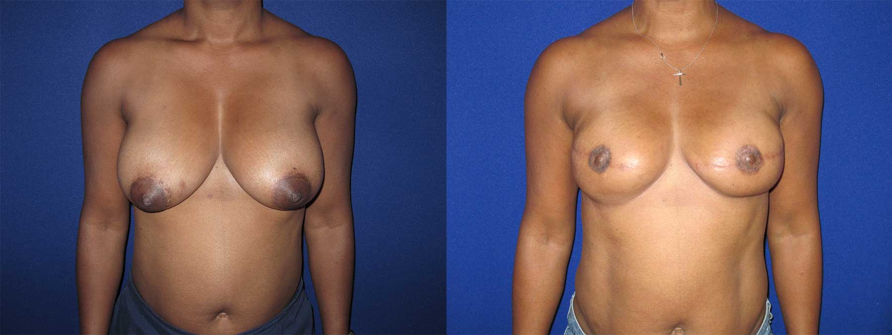 Before and After Image of Implant-Based Reconstruction