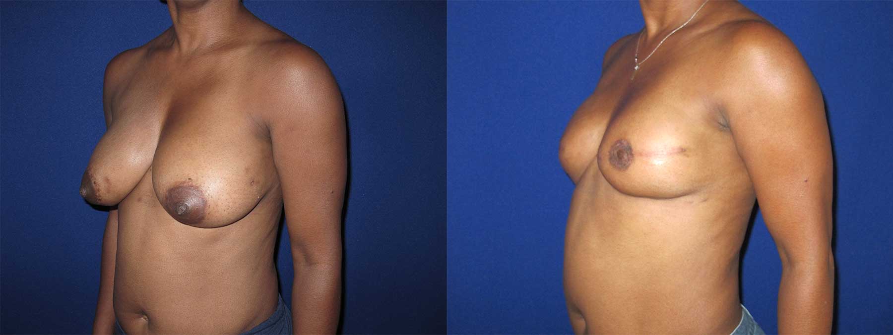 Before and After Image of Implant-Based Reconstruction