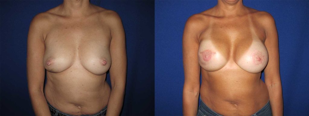 Before and After Image of Implant-Based Reconstruction