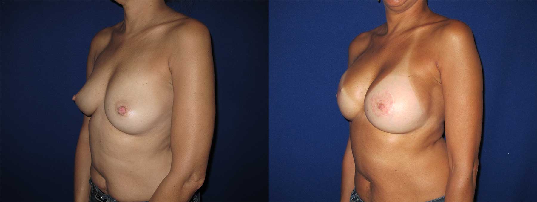 Before and After Image of Implant-Based Reconstruction