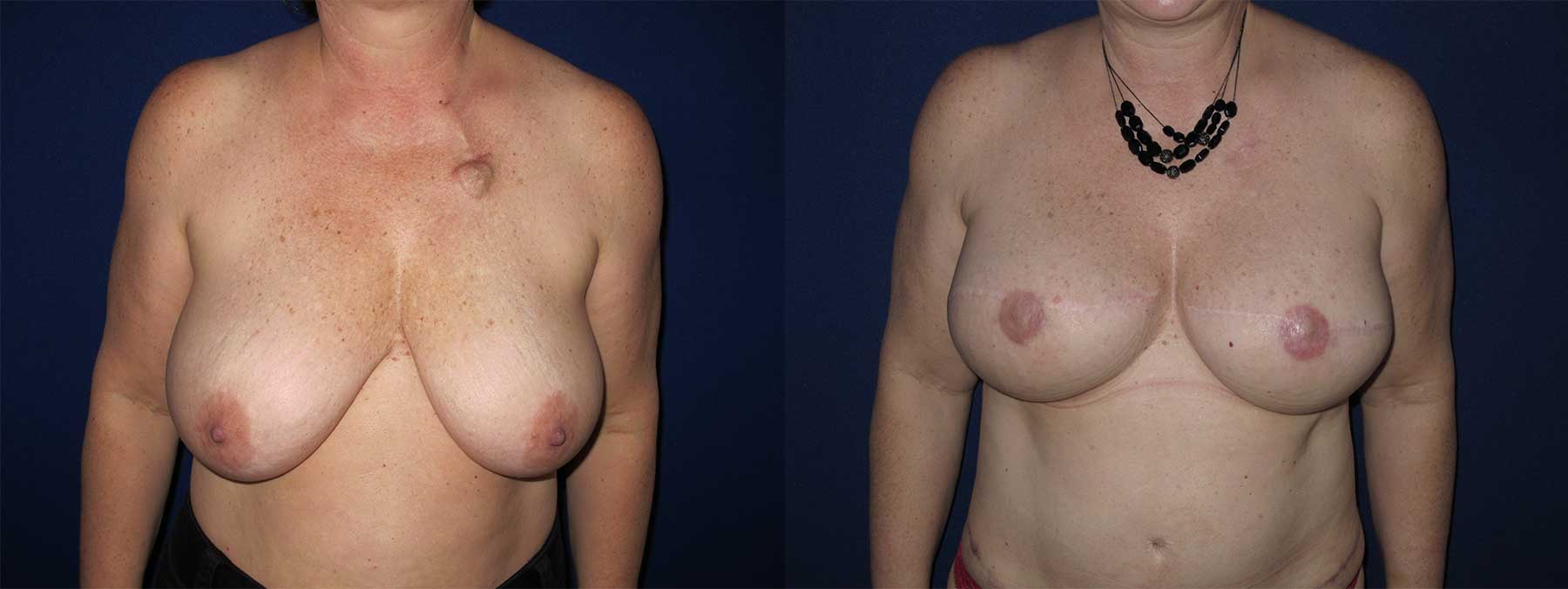 Before and After Image of Implant-Based Reconstruction