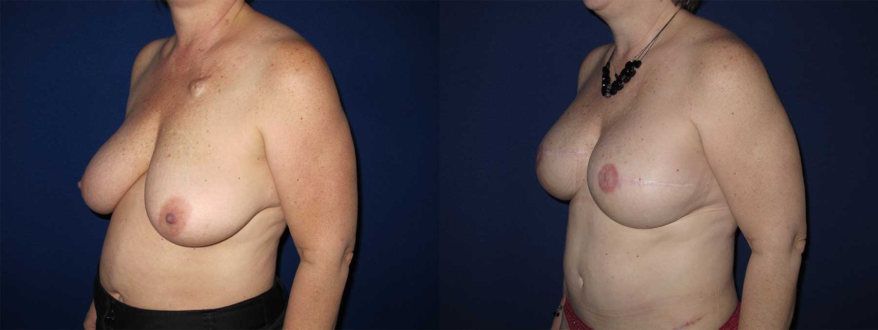 Before and After Image of Implant-Based Reconstruction