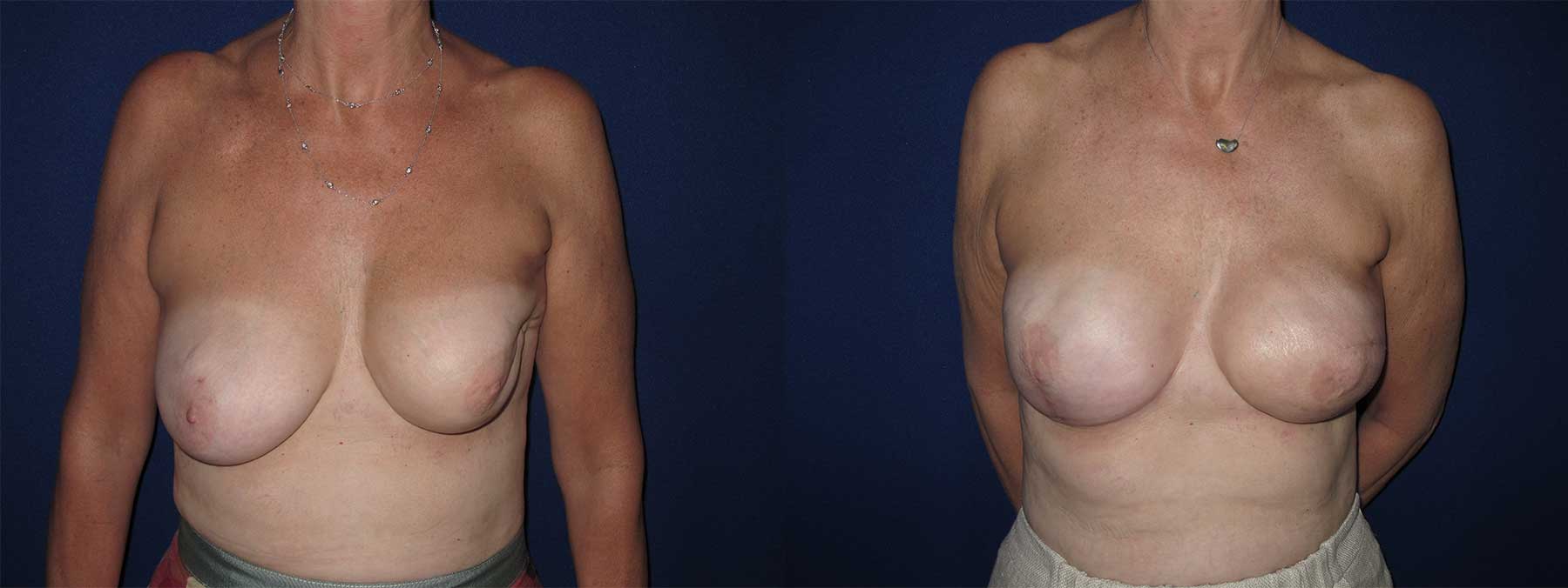 Before and After Image of Latissimus Flap Breast Reconstruction